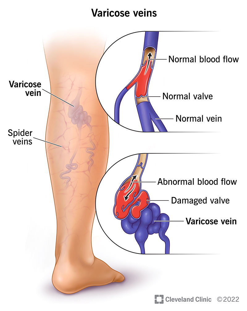 Varicose Veins: Causes, Symptoms and Treatment