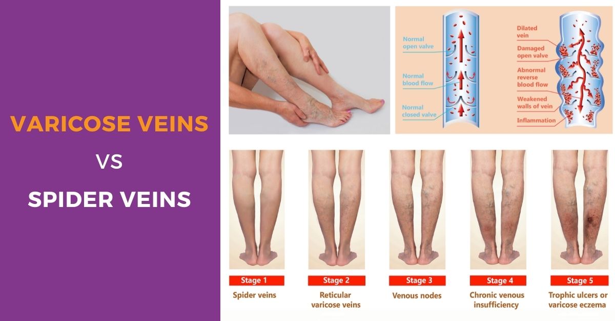 spider veins and varicose veins